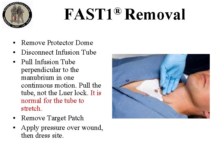 ® FAST 1 Removal • Remove Protector Dome • Disconnect Infusion Tube • Pull