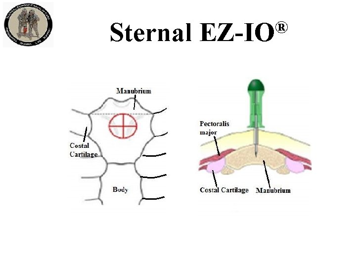 Sternal ® EZ-IO 