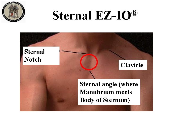 Sternal Notch ® EZ-IO Clavicle Sternal angle (where Manubrium meets Body of Sternum) 