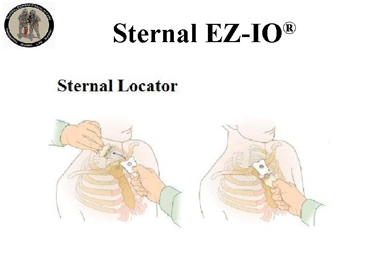 Sternal ® EZ-IO 