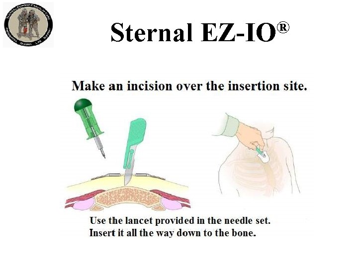 Sternal ® EZ-IO 