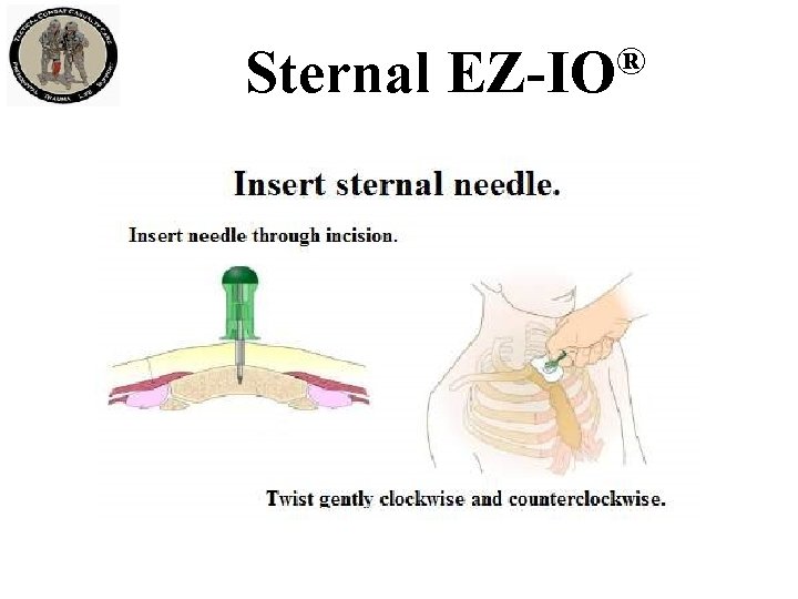 Sternal ® EZ-IO 