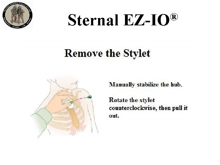 Sternal ® EZ-IO 