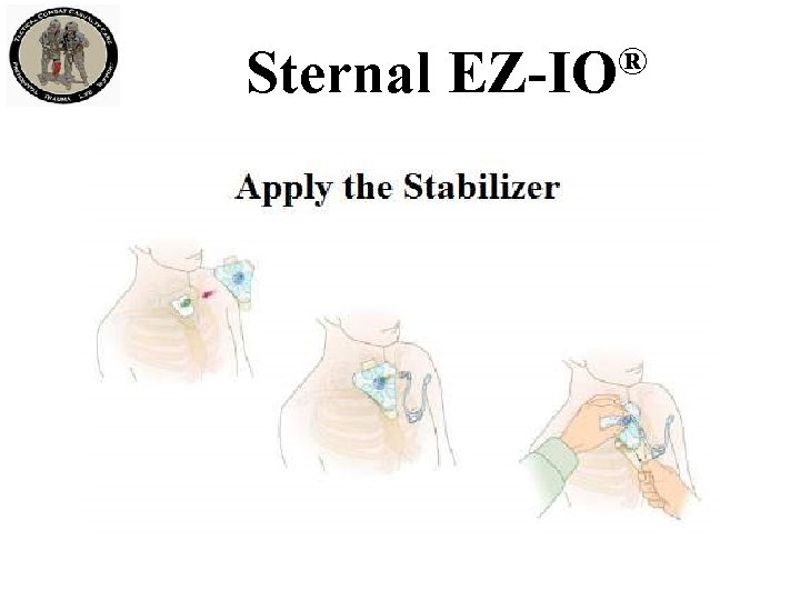 Sternal ® EZ-IO 