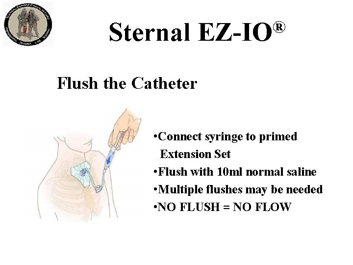 Sternal ® EZ-IO Flush the Catheter • Connect syringe to primed Extension Set •