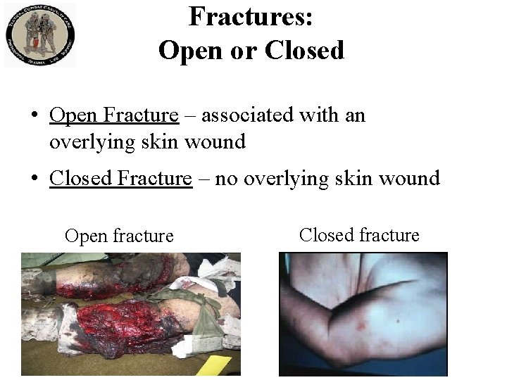 Fractures: Open or Closed • Open Fracture – associated with an overlying skin wound