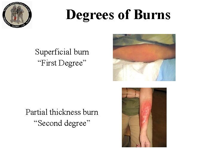 Degrees of Burns Superficial burn “First Degree” Partial thickness burn “Second degree” 