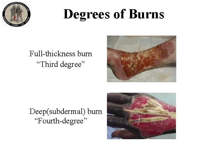 Degrees of Burns Full-thickness burn “Third degree” Deep(subdermal) burn “Fourth-degree” 