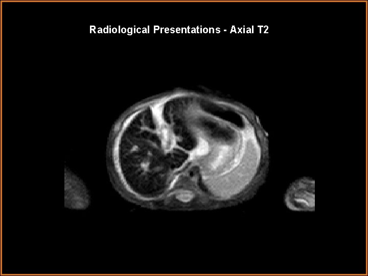 Radiological Presentations - Axial T 2 HI 