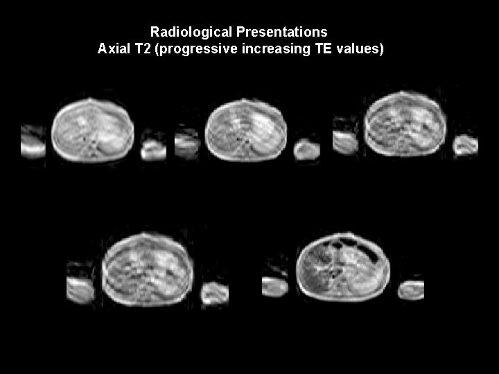 Radiological Presentations Axial T 2 (progressive increasing TE values) TR 2500 TE 6 TE