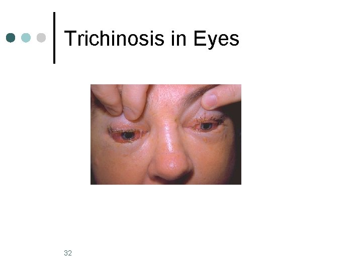 Trichinosis in Eyes 32 