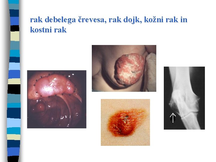 rak debelega črevesa, rak dojk, kožni rak in kostni rak 