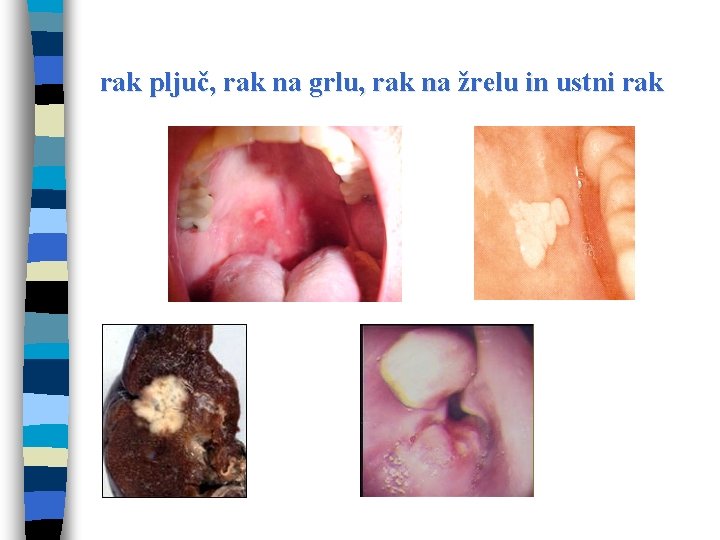 rak pljuč, rak na grlu, rak na žrelu in ustni rak 