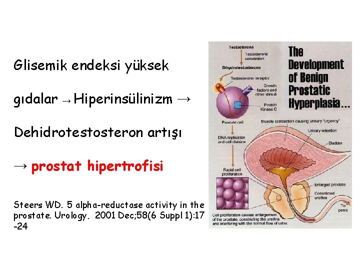 Glisemik endeksi yüksek gıdalar → Hiperinsülinizm → Dehidrotestosteron artışı → prostat hipertrofisi Steers WD.