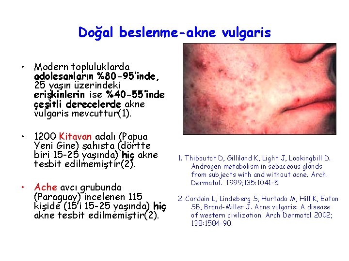 Doğal beslenme-akne vulgaris • Modern topluluklarda adolesanların %80 -95’inde, 25 yaşın üzerindeki erişkinlerin ise