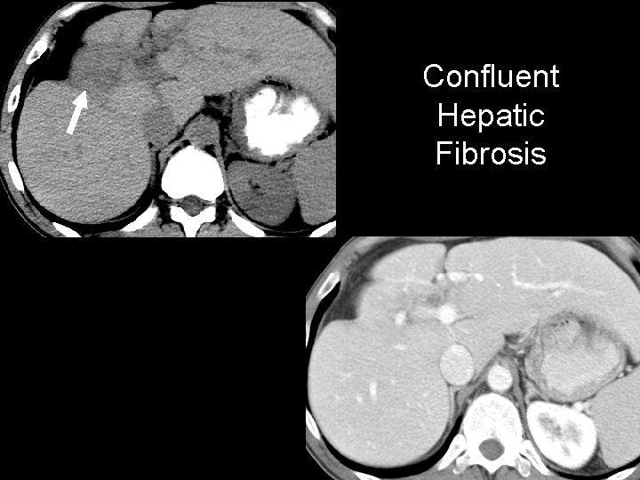 Confluent Hepatic Fibrosis 