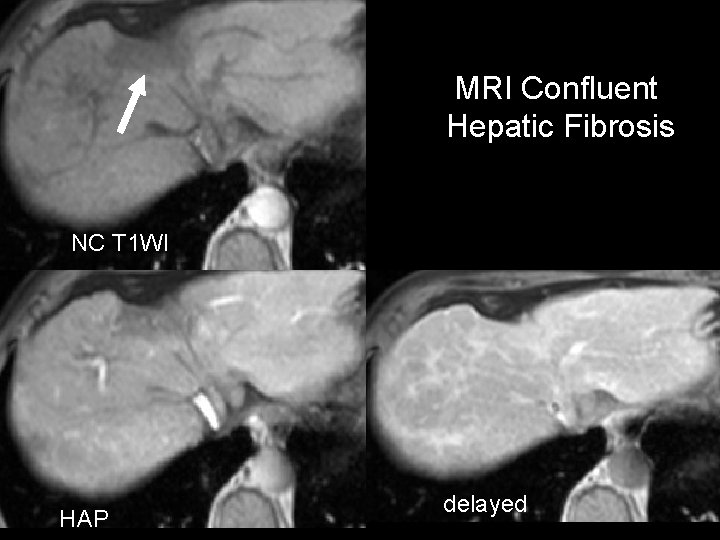 MRI Confluent Hepatic Fibrosis NC T 1 WI HAP delayed 
