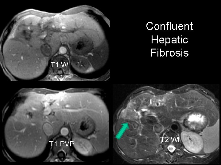 Confluent Hepatic Fibrosis T 1 WI T 1 PVP T 2 WI 