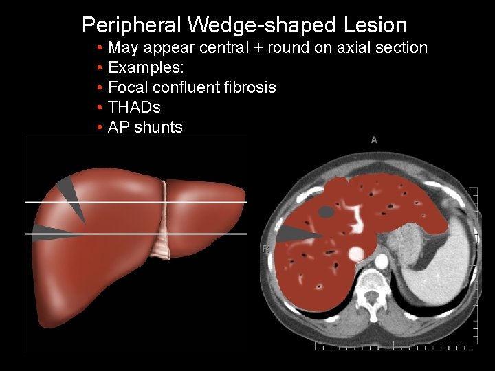 Peripheral Wedge-shaped Lesion • May appear central + round on axial section • Examples: