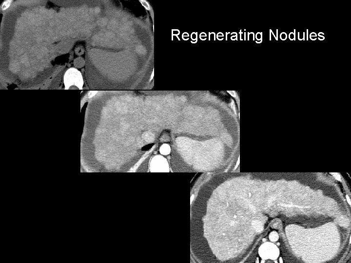 Regenerating Nodules 