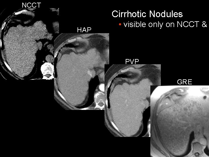 NCCT Cirrhotic Nodules HAP • visible only on NCCT & PVP GRE 