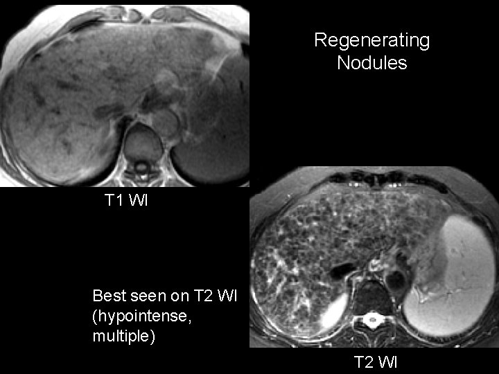 Regenerating Nodules T 1 WI Best seen on T 2 WI (hypointense, multiple) T