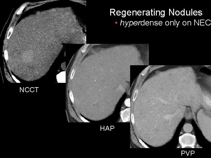 Regenerating Nodules • hyperdense only on NEC NCCT HAP PVP 