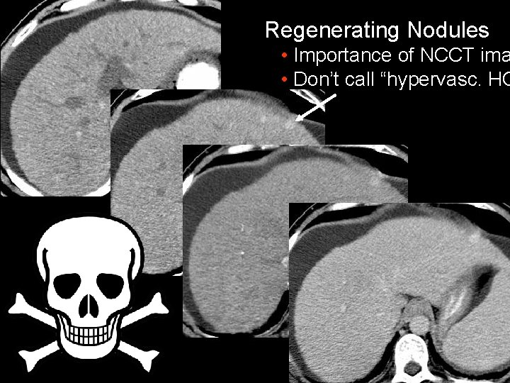 Regenerating Nodules • Importance of NCCT ima • Don’t call “hypervasc. HC 