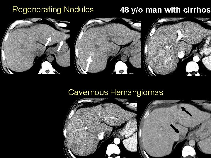 Regenerating Nodules 48 y/o man with cirrhosi Cavernous Hemangiomas 