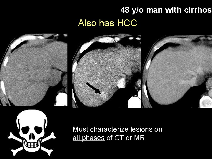 48 y/o man with cirrhosi Also has HCC Must characterize lesions on all phases