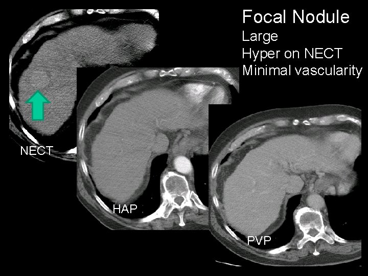 Focal Nodule Large Hyper on NECT Minimal vascularity NECT HAP PVP 