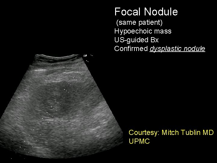Focal Nodule (same patient) Hypoechoic mass US-guided Bx Confirmed dysplastic nodule Courtesy: Mitch Tublin