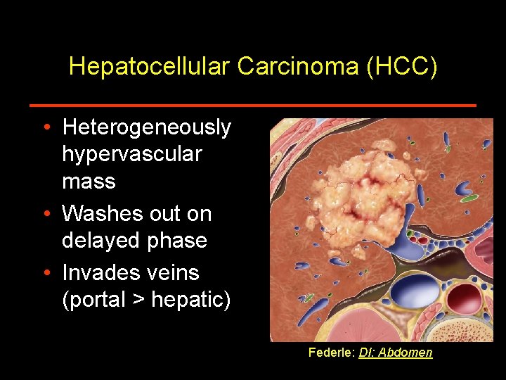 Hepatocellular Carcinoma (HCC) • Heterogeneously hypervascular mass • Washes out on delayed phase •