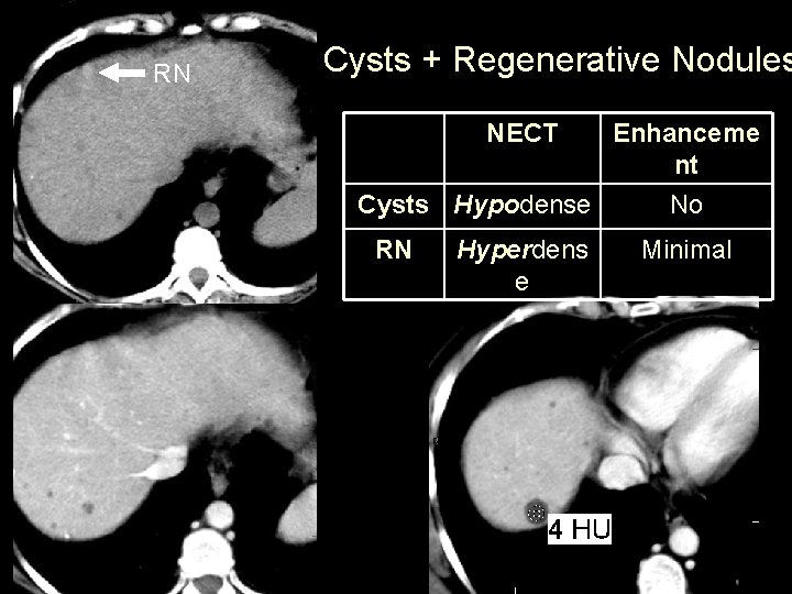 RN Cysts + Regenerative Nodules NECT Enhanceme nt Cysts Hypodense No RN Hyperdens e