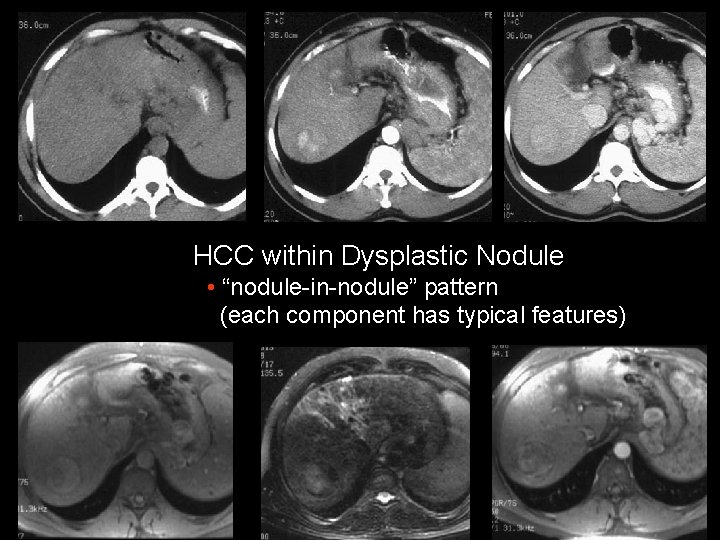 HCC within Dysplastic Nodule • “nodule-in-nodule” pattern (each component has typical features) 