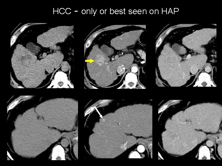 HCC - only or best seen on HAP 