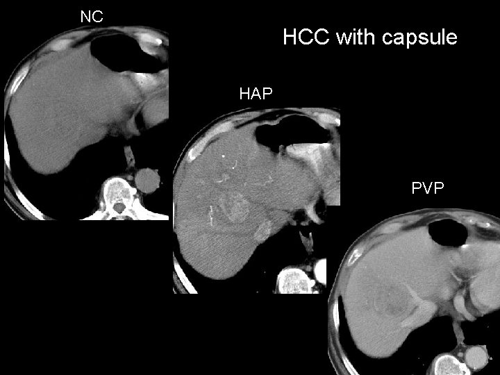 NC HCC with capsule HAP PVP 