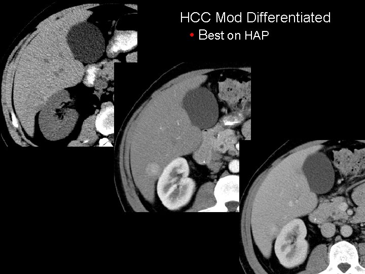HCC Mod Differentiated • Best on HAP 