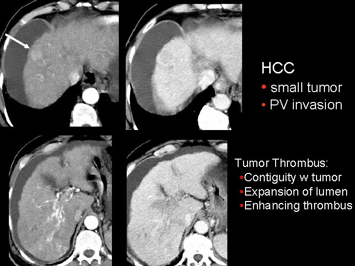 HCC • small tumor • PV invasion Tumor Thrombus: • Contiguity w tumor •