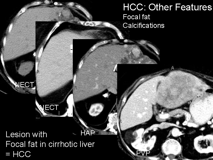 HCC: Other Features Focal fat Calcifications NECT HAP Lesion with Focal fat in cirrhotic