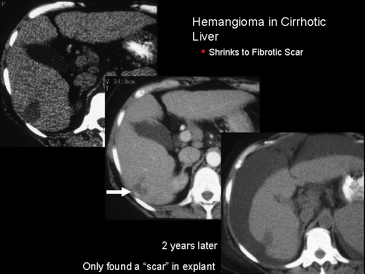 Hemangioma in Cirrhotic Liver • Shrinks to Fibrotic Scar 2 years later Only found