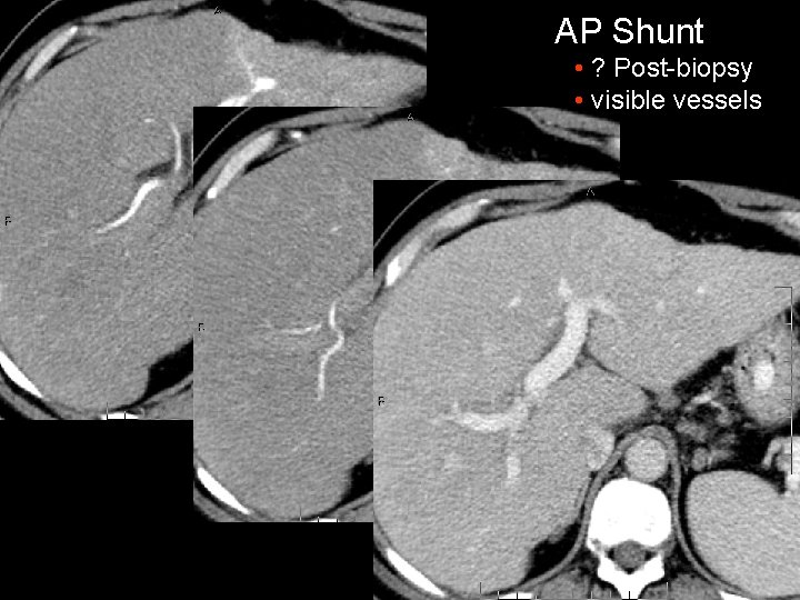 AP Shunt • ? Post-biopsy • visible vessels 