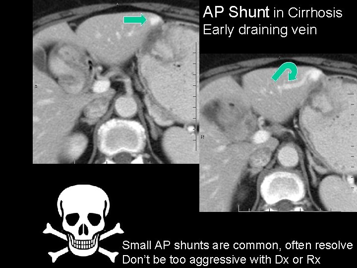 AP Shunt in Cirrhosis Early draining vein Small AP shunts are common, often resolve