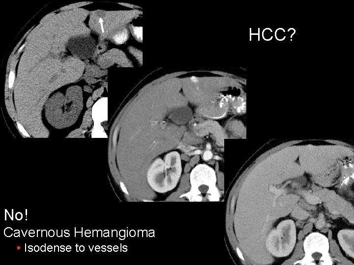 HCC? No! Cavernous Hemangioma • Isodense to vessels 