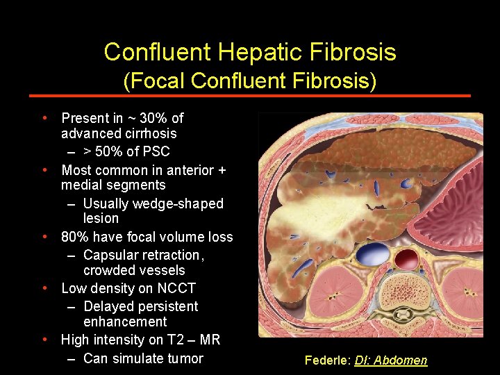 Confluent Hepatic Fibrosis (Focal Confluent Fibrosis) • Present in ~ 30% of advanced cirrhosis