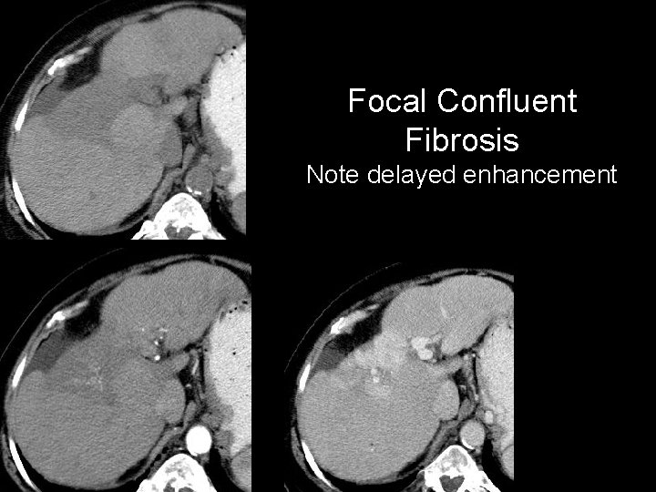 Focal Confluent Fibrosis Note delayed enhancement 