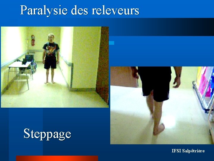 Paralysie des releveurs Steppage IFSI Salpêtrière Paralysie des releveurs Steppage IFSI Salpêtrière