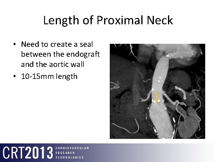 Length of Proximal Neck • Need to create a seal between the endograft and