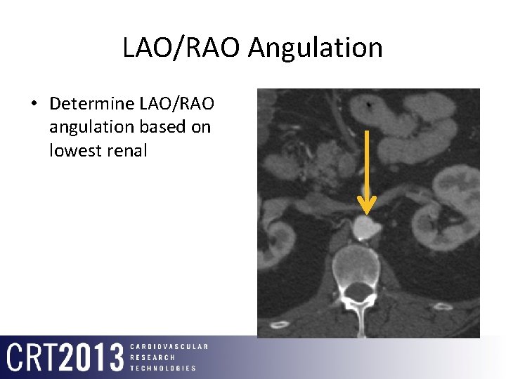 LAO/RAO Angulation • Determine LAO/RAO angulation based on lowest renal 