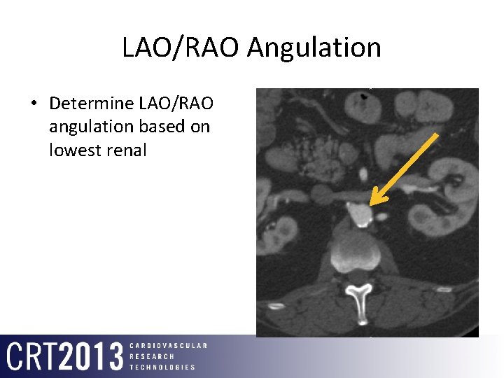 LAO/RAO Angulation • Determine LAO/RAO angulation based on lowest renal 